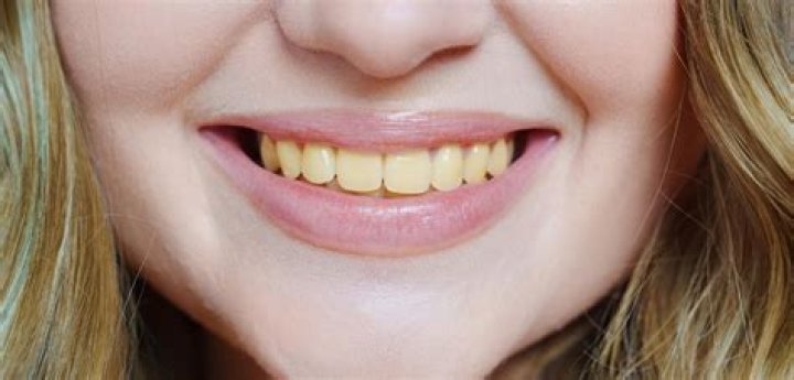 Will turmeric make my teeth yellow?