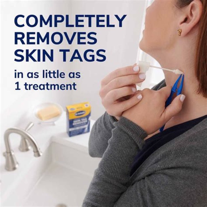 Will wax rip off a skin tag?
